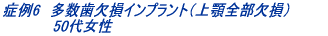 症例3 インプラント単独歯(左上3番) 53歳女性 治療期間6ヶ月